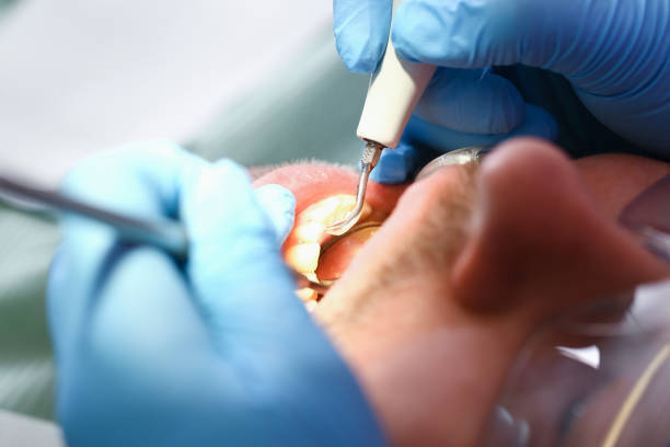 Best Emergency Treatment for Dental Infections or Abscesses in St Paul, MN